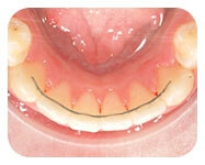 The inside of someone’s mouth displaying lingual braces