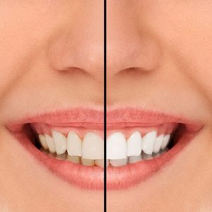 Before and after photo, showing a smile on one-half with faded teeth and the other half with bright white teeth
