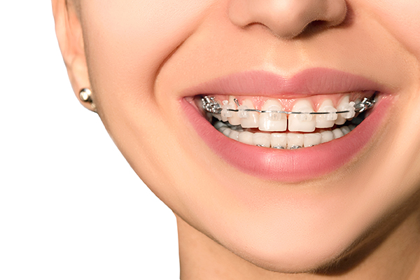 Dental Braces in Encino