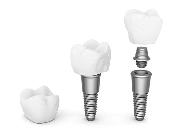 Dental Implant in Encino