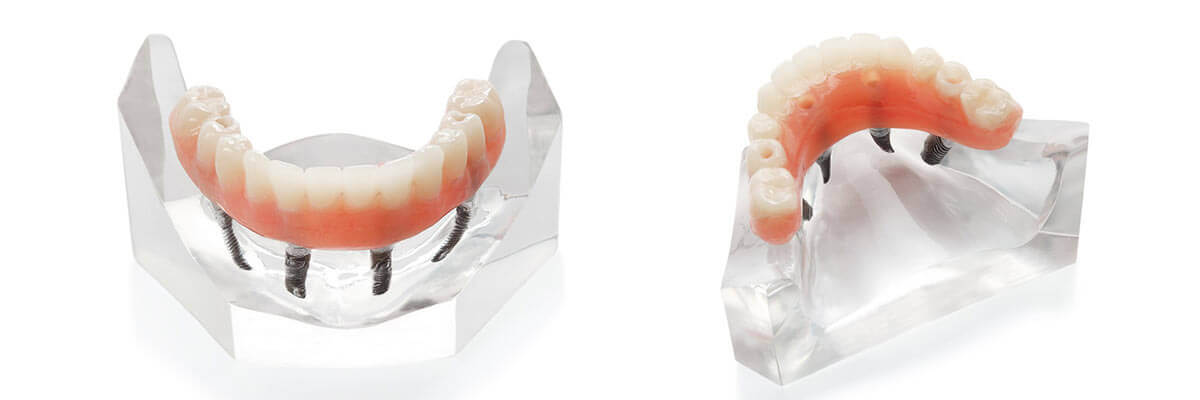 Full set of dental implants