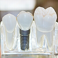 Mold of individual dental implant beside natural teeth