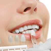 Woman with dental veneers and dental laminates