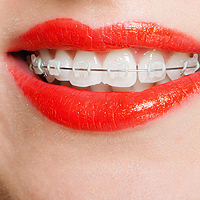 Smiling woman with braces