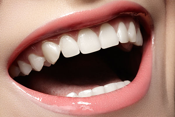 Veneers Dentist in Encino